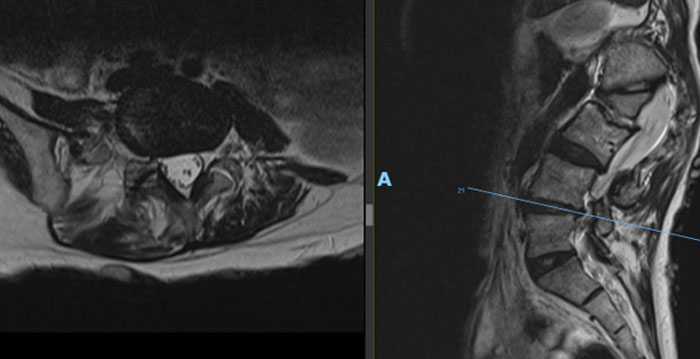 Preoperative MRI